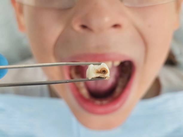Best Emergency Tooth Extraction in Burns, OR